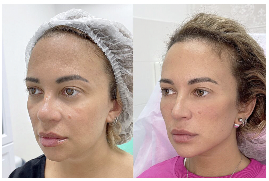 Комплексная гармонизация лица Full Face